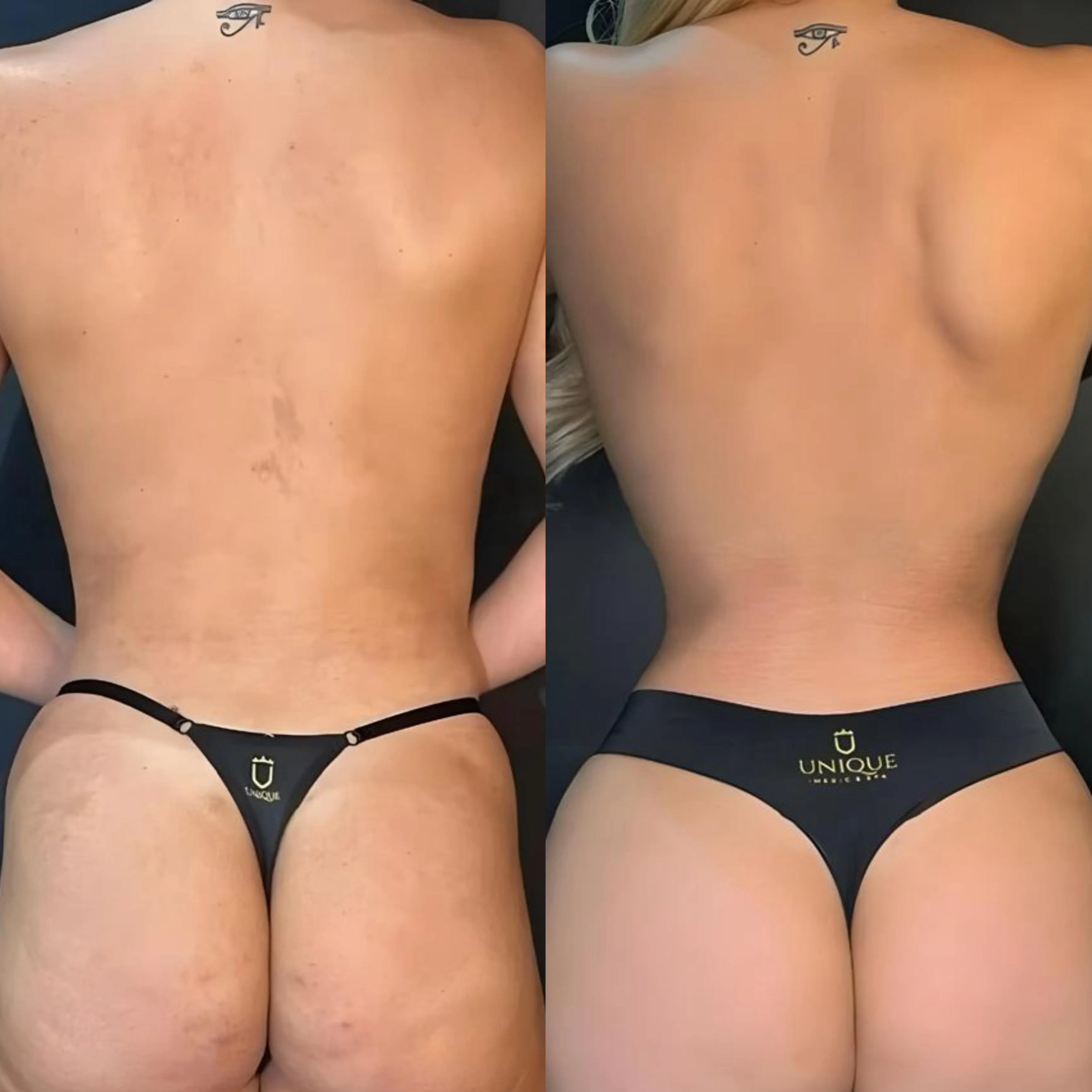 Antes e depois de Remodelação de Costelas na Unique