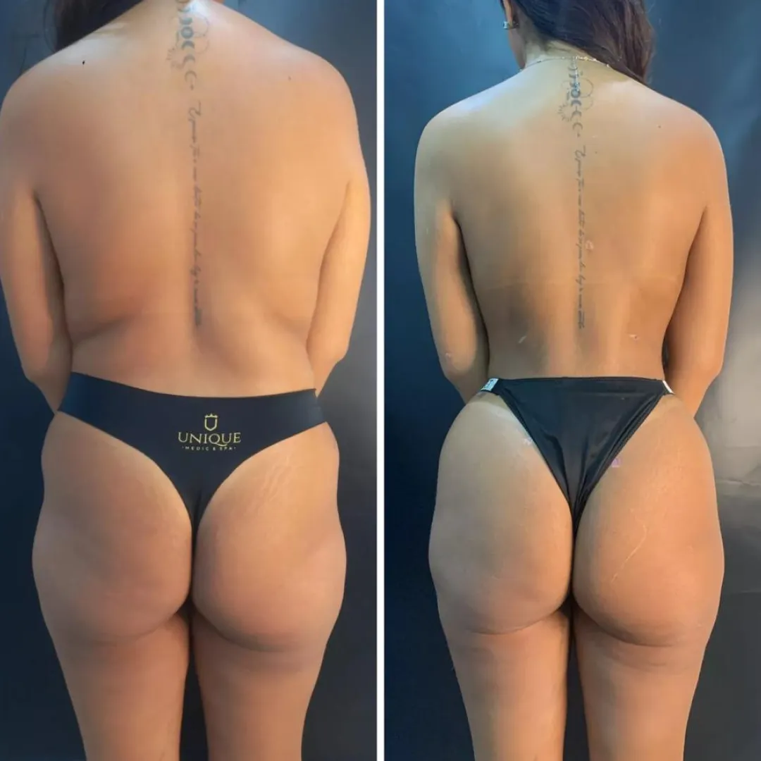 Antes e depois — resultado real